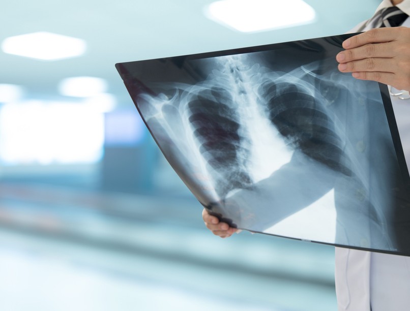 tüdőgyulladás veszélyes influenza szövődmény oltás