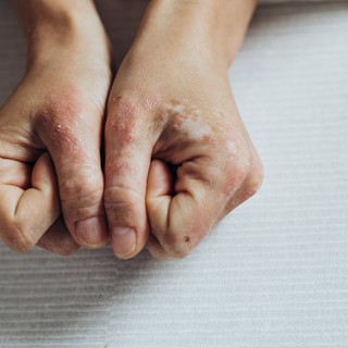 Mitől alakul ki a pikkelysömör? című cikk nyitóképe