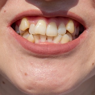 Egyenetlen fogsor, fogászati problémák című cikk nyitóképe