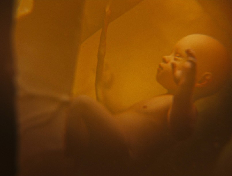 szifilisz veleszületett magyarország