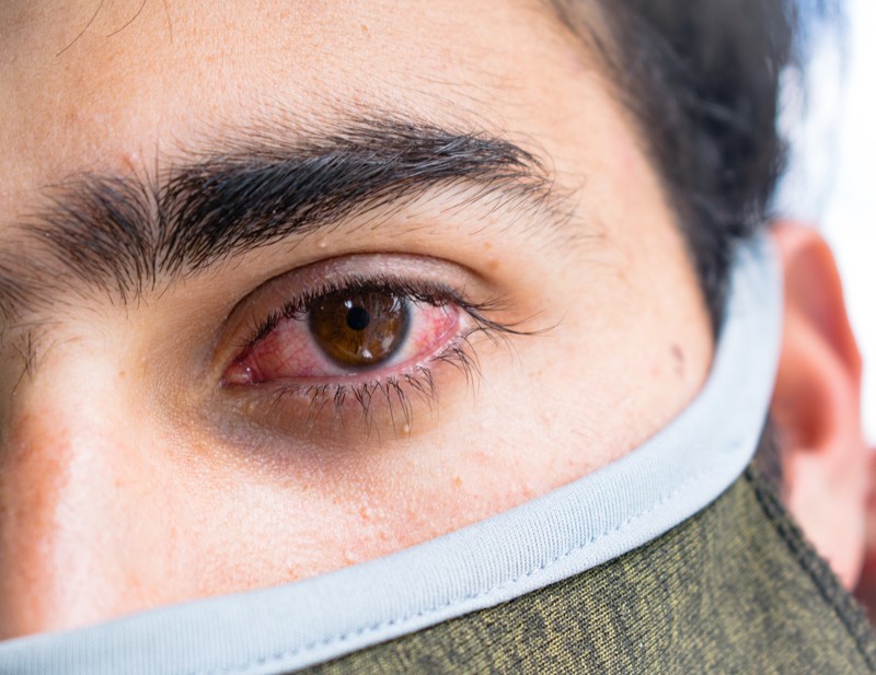 Feketegomba-fertőzés: a látásra is veszélyes lehet a delta variáns