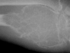Oszteoklasztóma: tünetek, vizsgálatok és kezelési lehetőségek