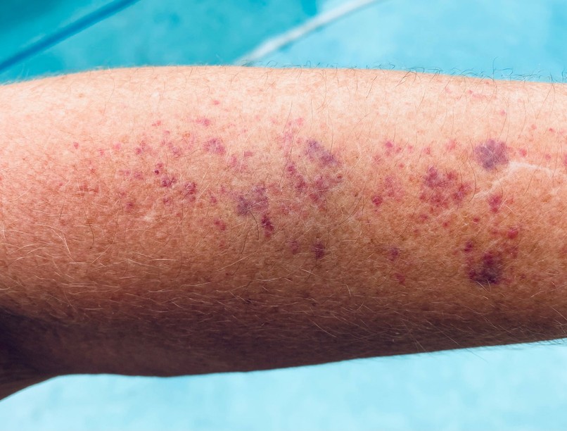 Mi a bőrvérzés purpura bevérzés