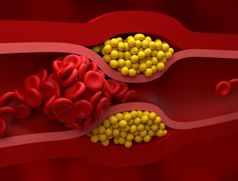 magas vérnyomás koleszterin ellen mozgás edzés