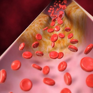 Familiáris hiperkoleszterinémia - Életet menthet a korai felismerés című cikk nyitóképe