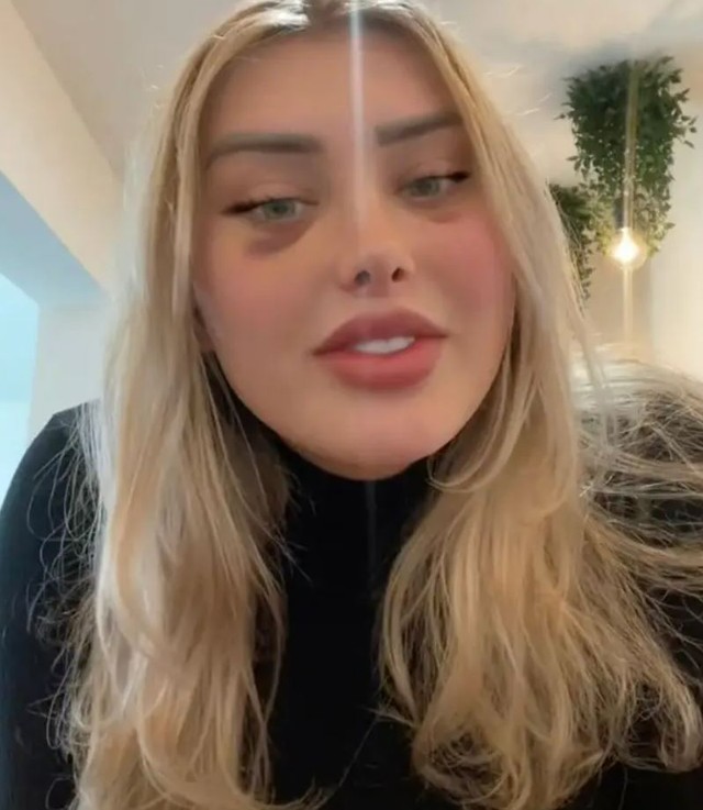 Szétnyílt egy frissen plasztikázott nő tarkója a repülőn