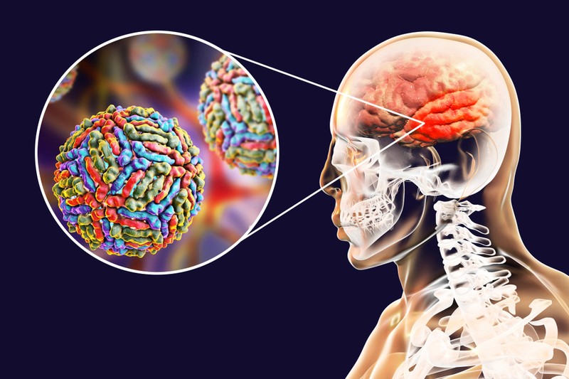 Nyugat-nílusi láz: Magyarországon kirívóan sok a beteg