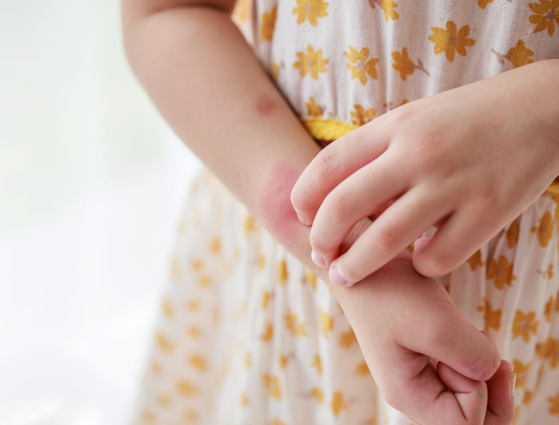 ekcéma bőr ápolás gyermekeknél hogyan