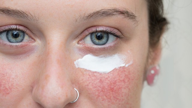 Rosacea és UV sugárzás: hogyan védekezzünk?