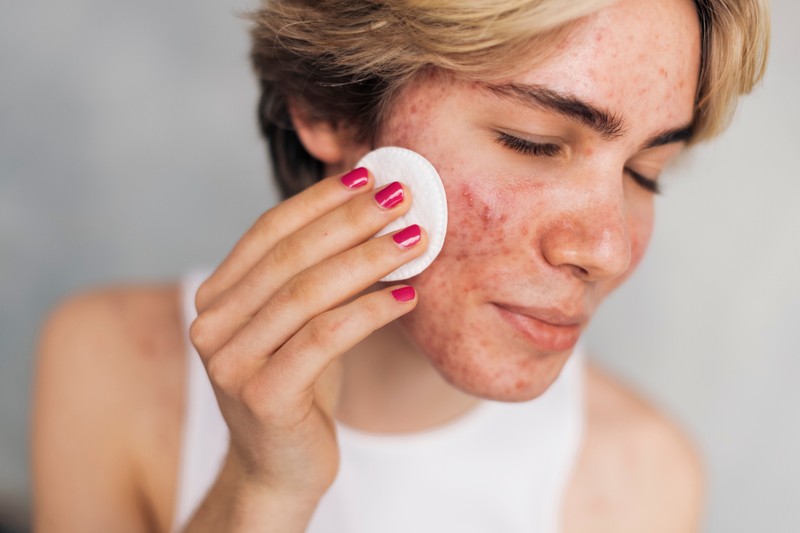 Hogyan befolyásolja a szőrtüszőgyulladás az akné kialakulását?