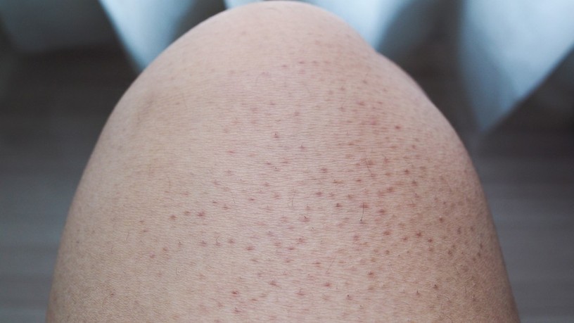 grízes bőr, keratosis, pilaris, libabő, csirkebőr, göbök, kiütés, száraz bőr, keratin