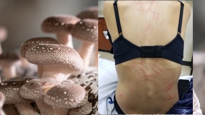 Mintha megkorbácsolták volna: furcsa kiütések jelentek meg egy nő hátán miután shiitake gombát evett című cikk nyitóképe