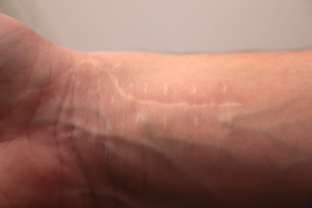 Meglepő, de a seb nem felejt! Egy régi heg is okozhat derékfájást, székrekedést, vagy akár meddőséget