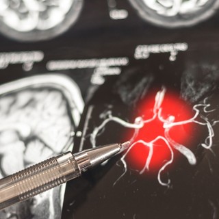 Forradalmi fordulat az Alzheimer-kutatásban: a K-vitamin új változata képes újjáépíteni az agysejteket című cikk nyitóképe