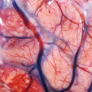 Agyhártyagyulladás-járvány: a halálos fertőzés korai jelei, amelyeket mindenkinek ismernie kell című cikk nyitóképe