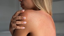 Ez a kellemetlen allergia az egész nyaralást tönkreteheti – amint jelentkezik árnyékba kell húzódni! című cikk nyitóképe
