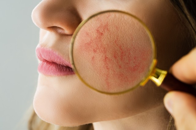 Rosacea - ezzel az 5 dologgal vigyázzon, ha érinti a probléma