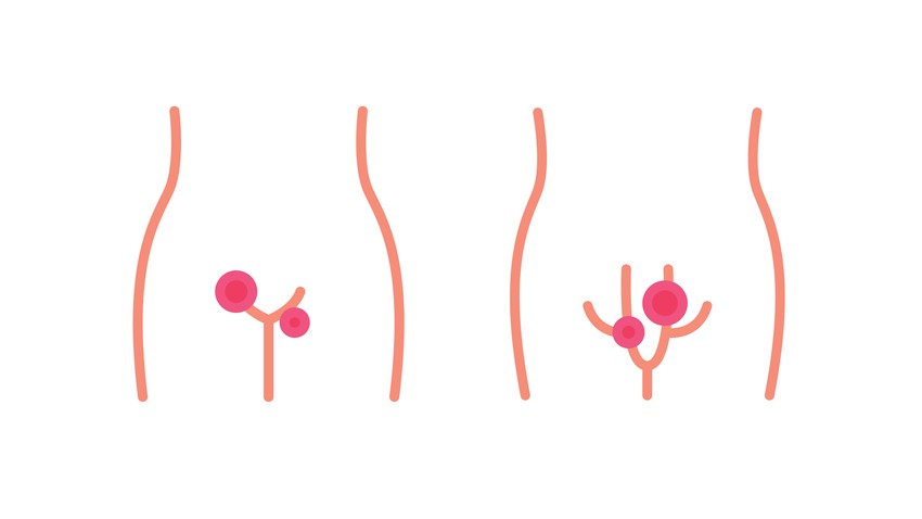 A vírus apró nyálkahártya-sérüléseken keresztül képes fertőzni. A fertőzés kapuja nőknél a vulva, a hüvelybemenet és a méhszáj, férfiaknál a makk, a fityma és a pénisz bőrfelülete. 