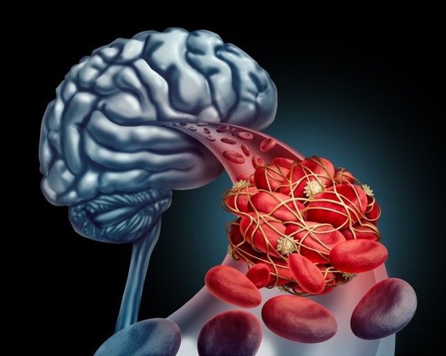 Koronavírus: stroke-ot okozhat a covid fiataloknál