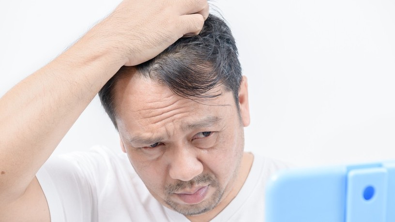 kopaszodás, hajhullás, haj, őssejt