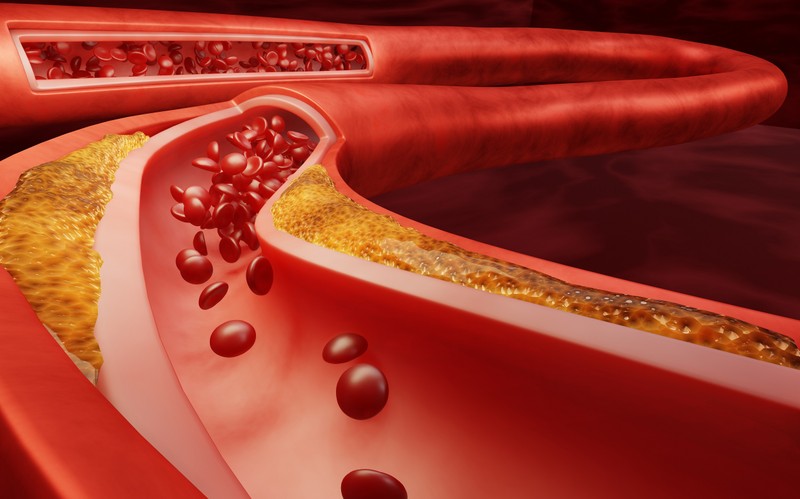 Mit érez, akinek agyvérzése van? 7 jel, amikor már mentőt kell hívni!