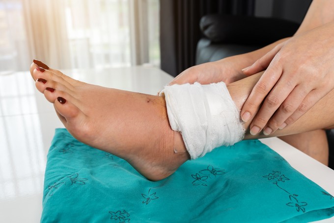 Lábszárfekély kezelése házilag: mikor lehetséges a seb otthoni kezelés, és mikor nem? című cikk nyitóképe