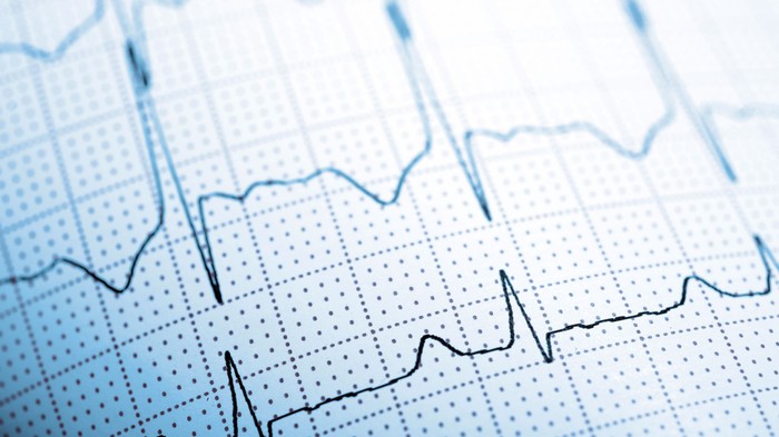 Gyorsabban olvassa az EKG-t, mint az orvosok? Egy új AI-eszköz másodpercek alatt kiszúrja a két legveszélyesebb szívbetegséget az EKG-ból című cikk nyitóképe