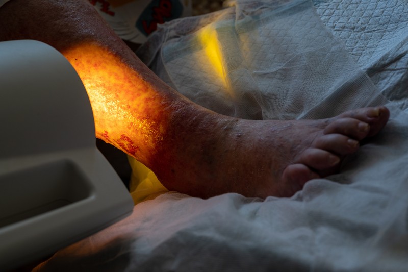 Lábszárfekély oka tünetei kezelése