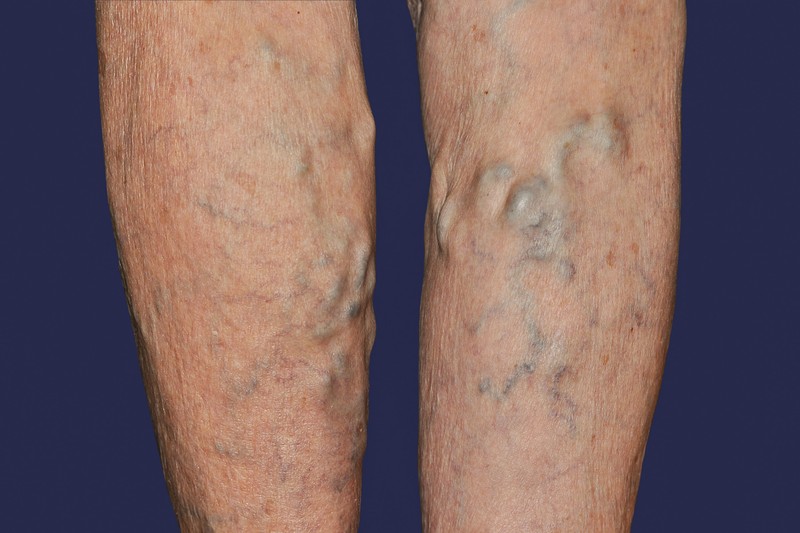 Kidudorodó, kanyargós visszerek:  a vénás trombózis csendben okozhat bajt