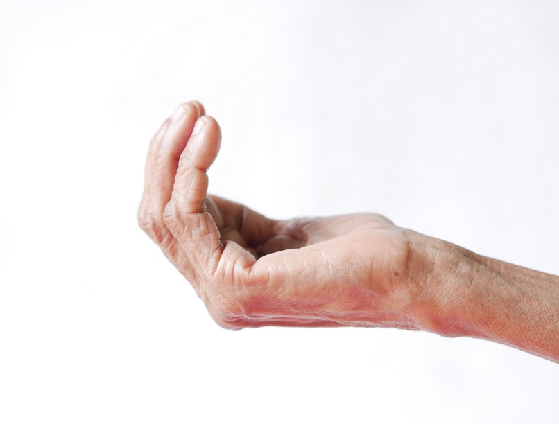 ujj tenyér daganat rák tumor