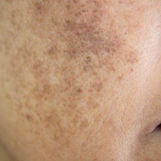 Kezd májfoltos lenni az arca? A bőrgyógyász elárulta, hogyan halványítók a foltok című cikk nyitóképe