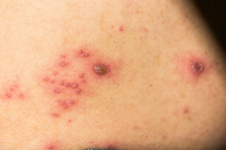 Viszkető hójagok jelennek meg a bőrön, amik később pörsenésekké alakulnak.