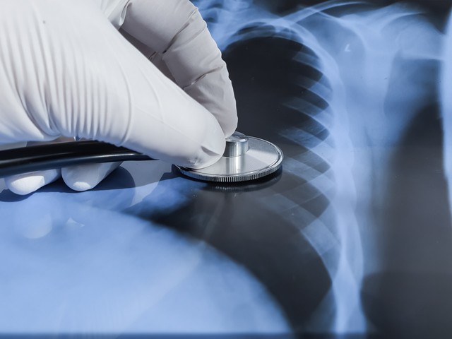 Aggasztó a TBC-növekedés Európában - azonnali intézkedéseket sürget a WHO