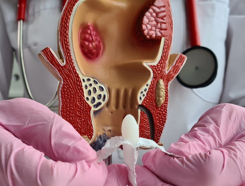 házi hüvely végbél kúp propolisz aloe