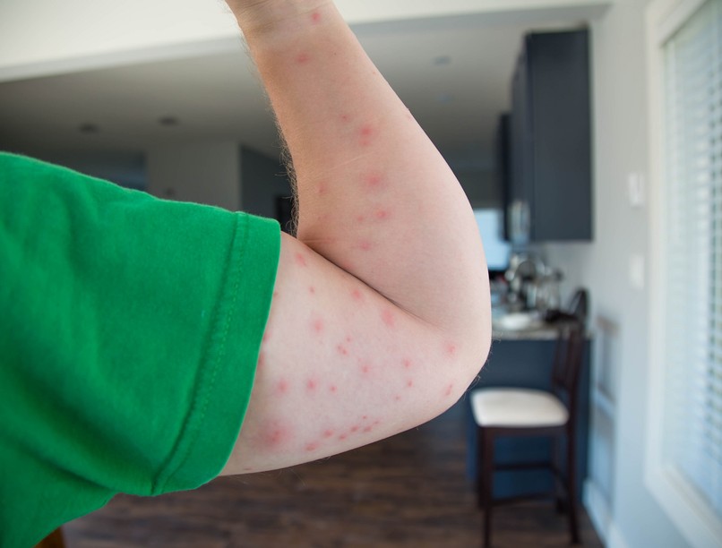 poloska pók rovar méh szúnyog bolha csípés fertőzés