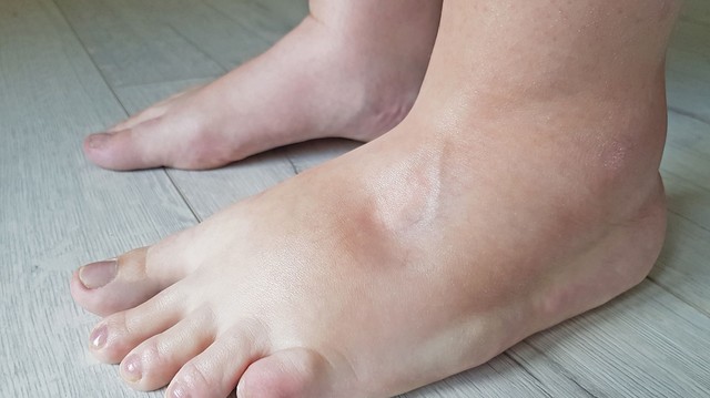 Nyomja meg pár másodpercre a bokáját: ha mélyedés marad utána, szívbetegség is állhat a háttérben