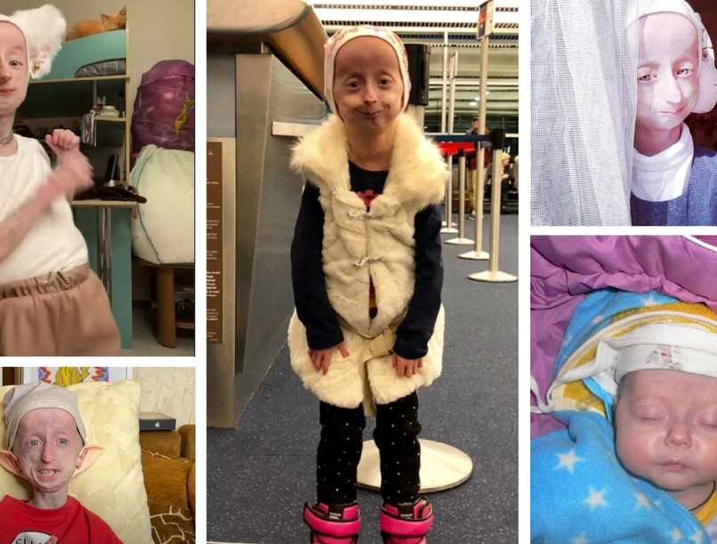 Dobbie, öregedés ellen, progéria Anja Korchagina, Dobby