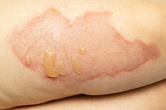 Bőrállapot-scannert rak a Google a mobilokba - így működik