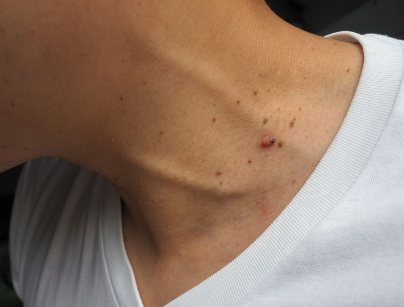 anyajegyszűrés szemölcs fibroma cukorbetegség