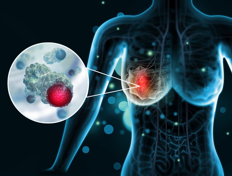 komplex emlőszűrés mammográfia ultrahang emlőrák emlődaganat