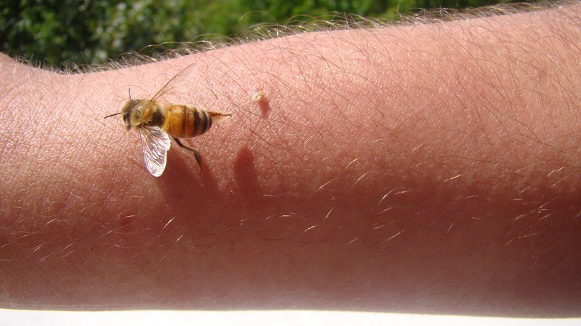 Allergia rovarcsípés után mit kell tenni