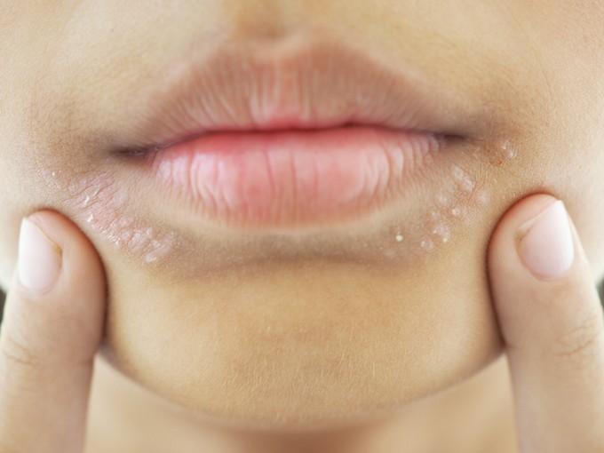 Az immunrendszer néha téved, és nem kér elnézést – ezt üzeni a bőr az ételallergiáról című cikk nyitóképe