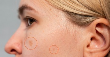  Miért jelenhetnek meg idő előtt az öregségi foltok, és mit kezdhetünk velük? 