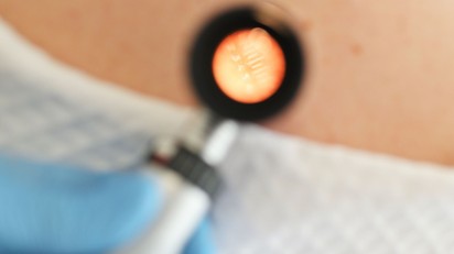 Ezért fontos télen ellenőrizni magunkon az anyajegyeket: 5 jel, ami melanómára utalhat című cikk nyitóképe