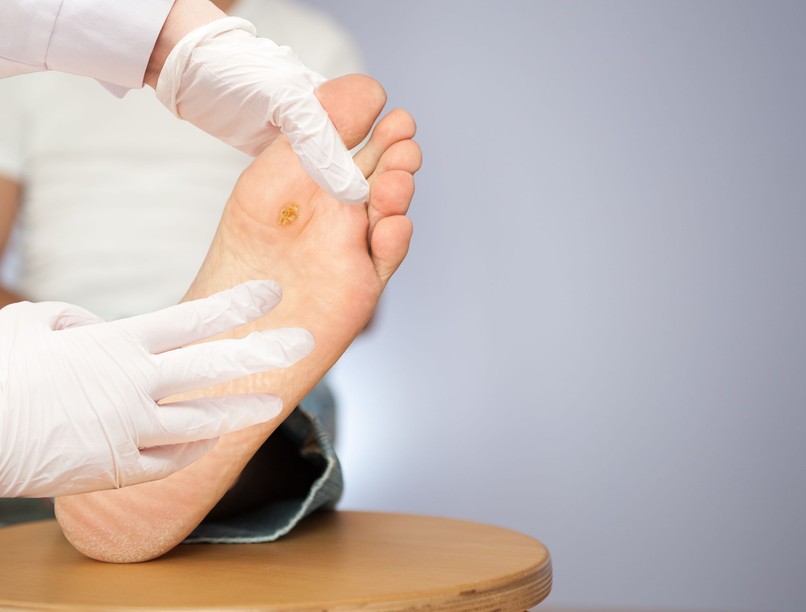 szemölcs ellen mi a jó kezelés