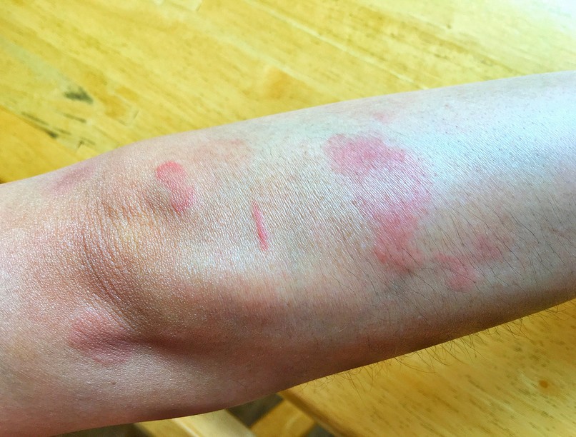 kiütés autoimmun betegség lupusz lupus