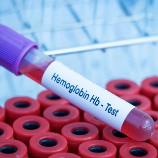 Nagyon alacsony a hemoglobin szintem - mit tegyek? Az orvos válaszol című cikk nyitóképe