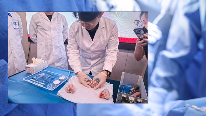 Egy kínai  ortopéd sebész 3 perc alatt meggyógyította a csontokat - osztrigaragasztót használt hozzá című cikk nyitóképe