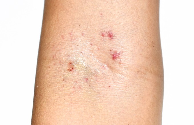 Leukémia - ilyen külső tünetek jelezhetik című cikk nyitóképe