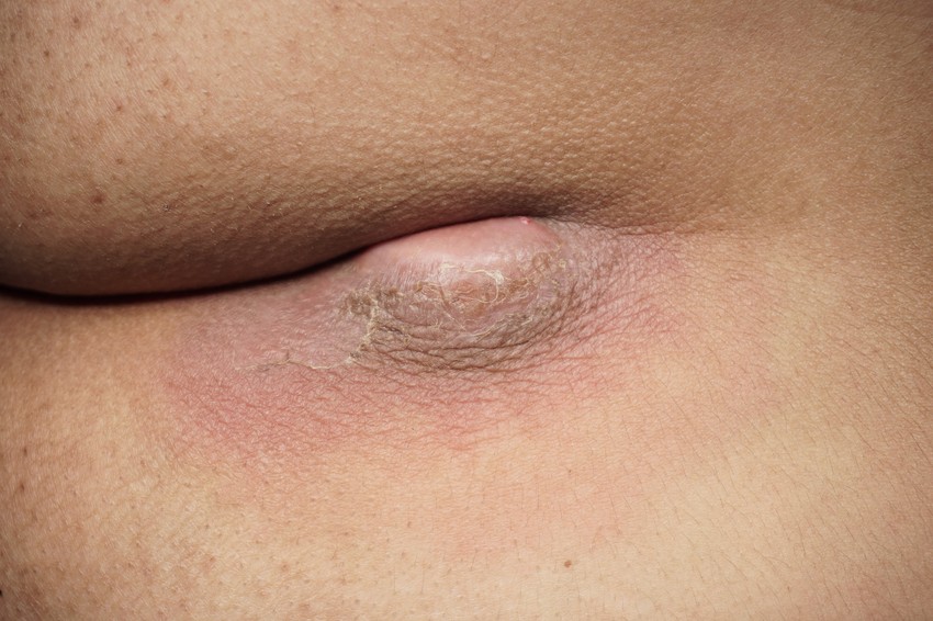 A pilonidális ciszta, nevezik pilonidális betegségnek is, egy krónikus bőrfertőzés, amely a farpofák között, a farokcsonthoz közel alakulhat ki.